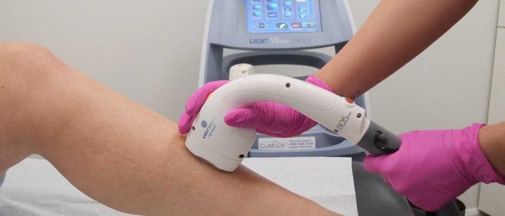 Séance d'épilation laser sur la jambe à la clinique Esthétèque